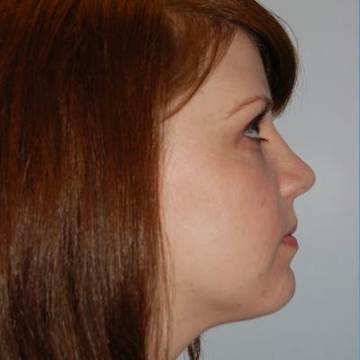 Revision Rhinoplasty Before & After Gallery - Patient 306733 - Image 2