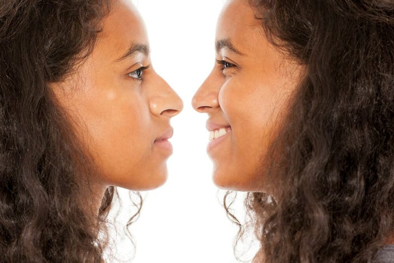 woman before & after nose surgery