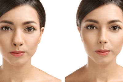 before and after rhinoplasty