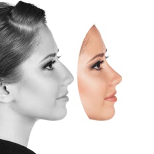 rhinoplasty