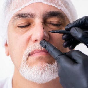 rhinoplasty