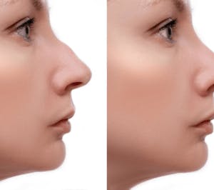 rhinoplasty in Beverly Hills