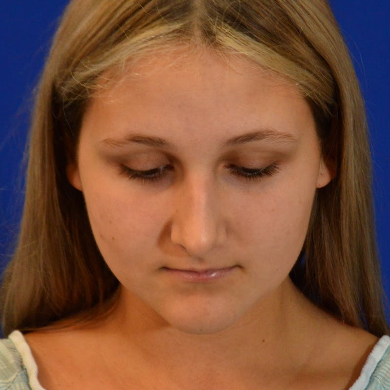 Female Rhinoplasty Before & After Gallery - Patient 293180 - Image 13