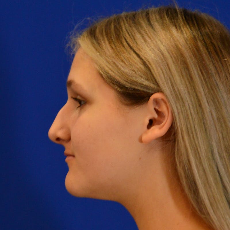 Female Rhinoplasty Before & After Gallery - Patient 293180 - Image 1
