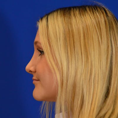 Female Rhinoplasty Before & After Gallery - Patient 293180 - Image 2