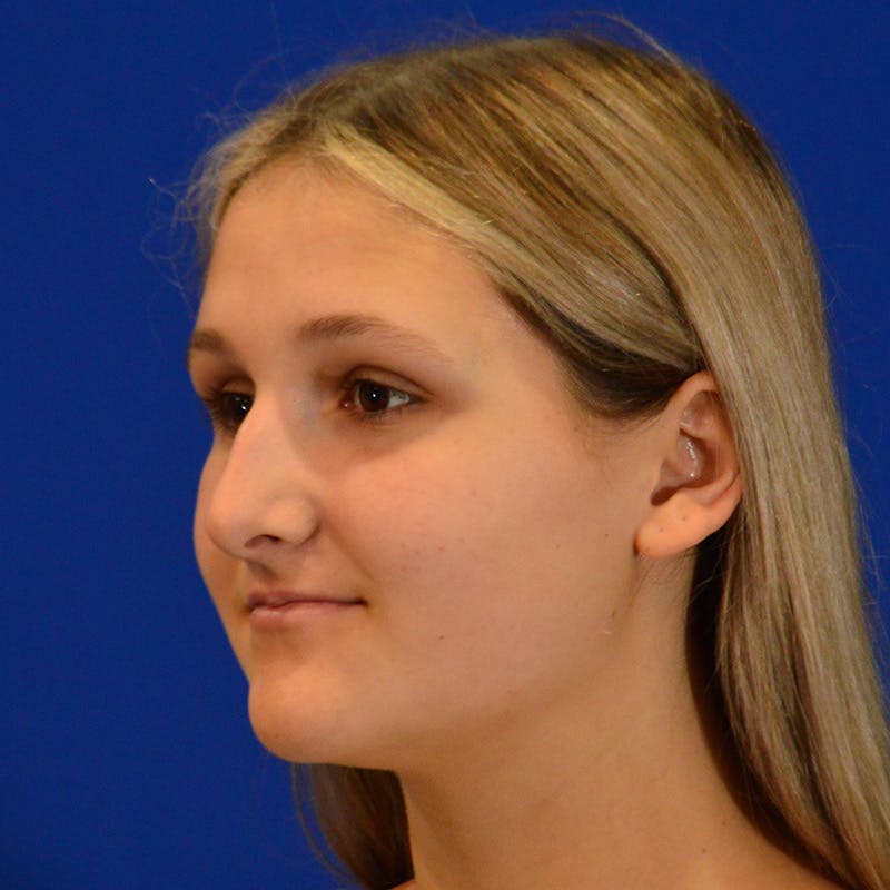 Female Rhinoplasty Before & After Gallery - Patient 293180 - Image 5