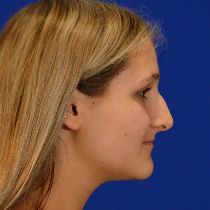 Female Rhinoplasty Before & After Gallery - Patient 293180 - Image 7
