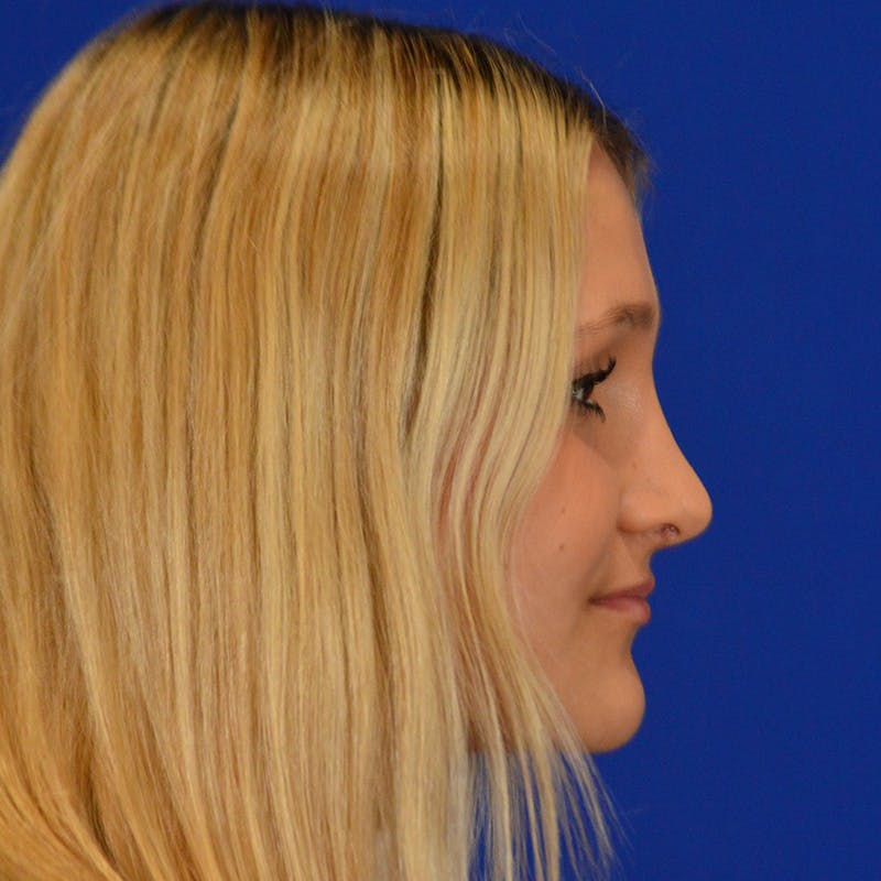 Female Rhinoplasty Before & After Gallery - Patient 293180 - Image 8