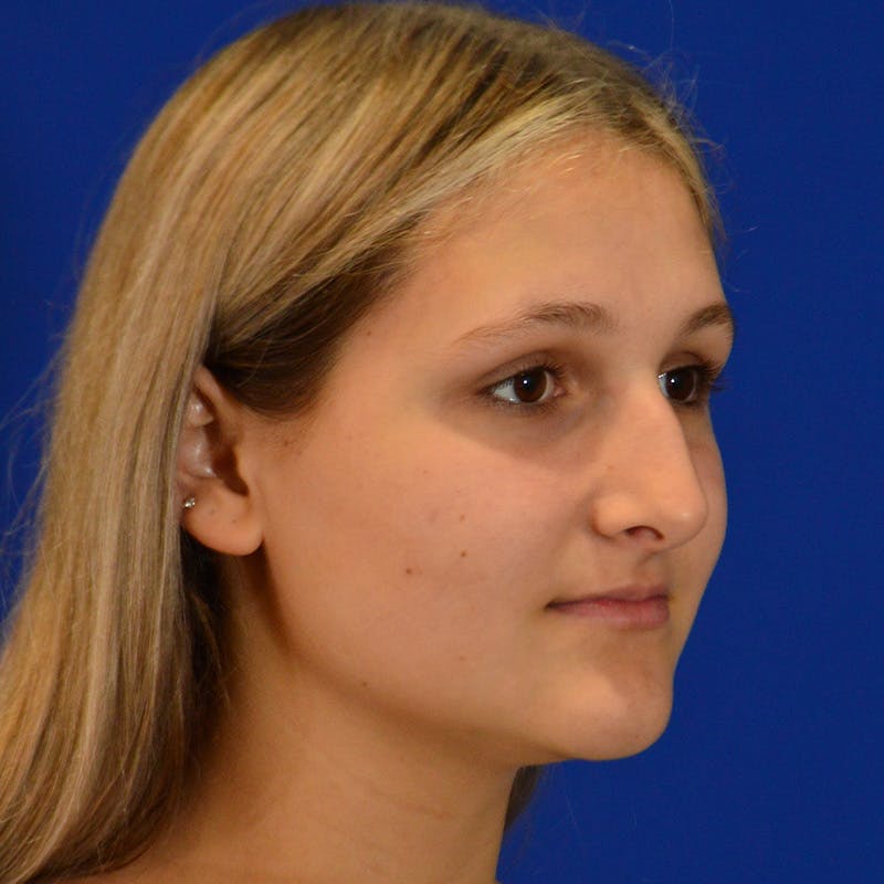 Female Rhinoplasty Before & After Gallery - Patient 293180 - Image 9