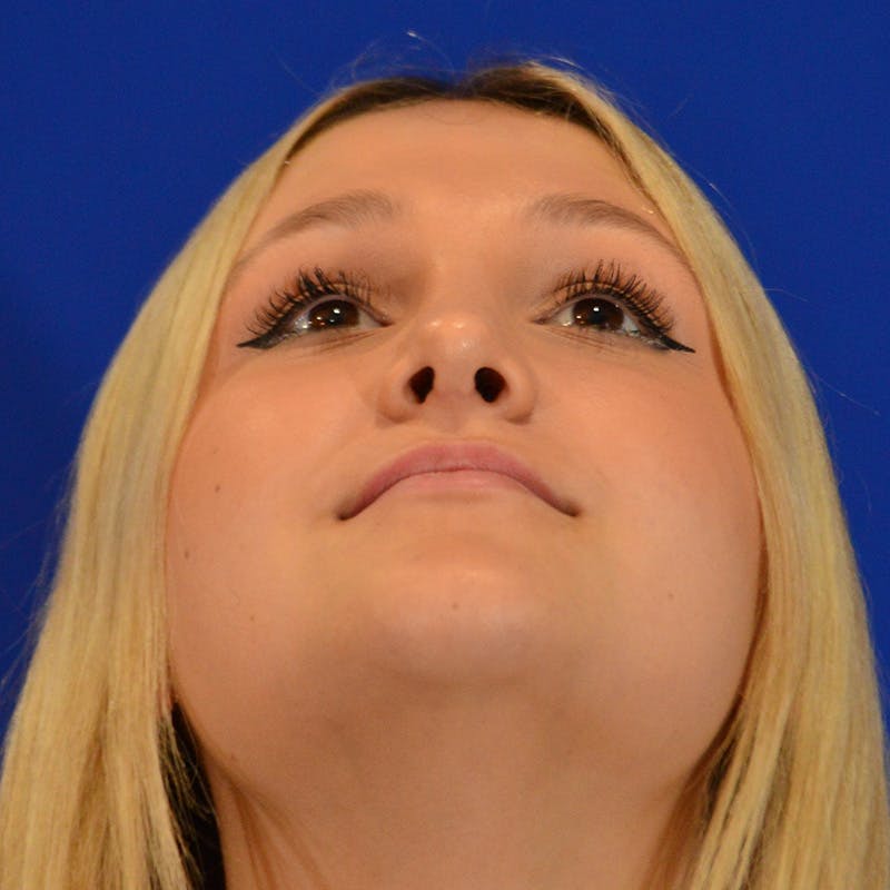 Female Rhinoplasty Before & After Gallery - Patient 293180 - Image 12