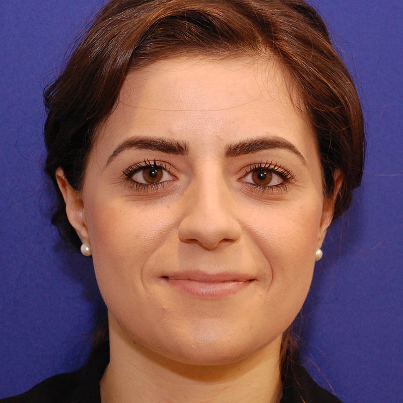 Female Rhinoplasty Before & After Gallery - Patient 215142 - Image 3