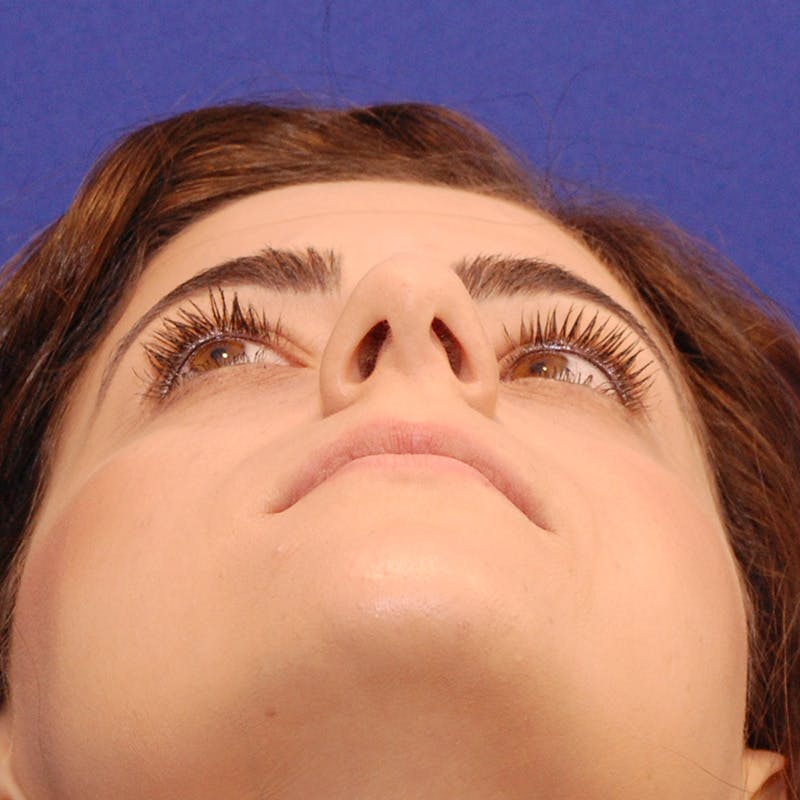 Female Rhinoplasty Before & After Gallery - Patient 215142 - Image 13