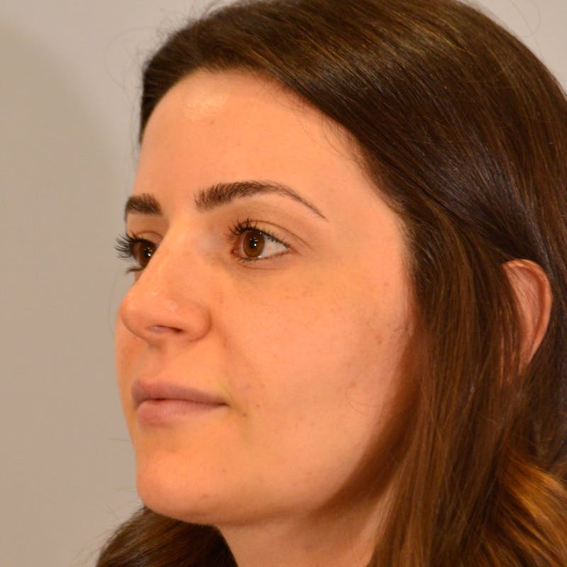Female Rhinoplasty Before & After Gallery - Patient 215142 - Image 10
