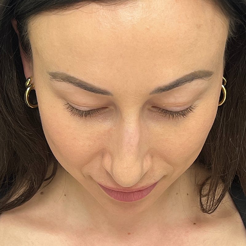 Female Rhinoplasty Before & After Gallery - Patient 167928 - Image 15