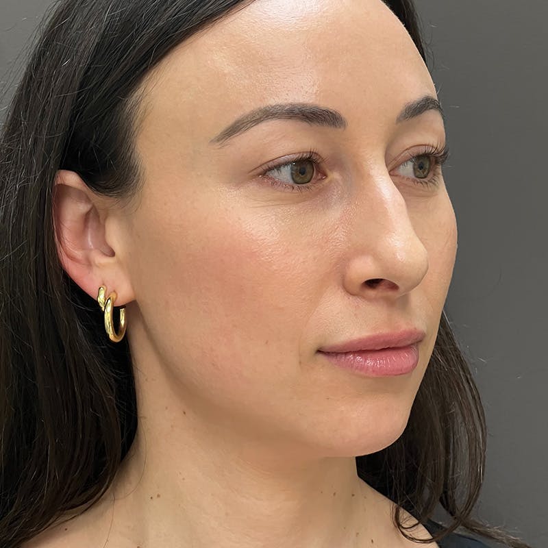 Female Rhinoplasty Before & After Gallery - Patient 167928 - Image 5