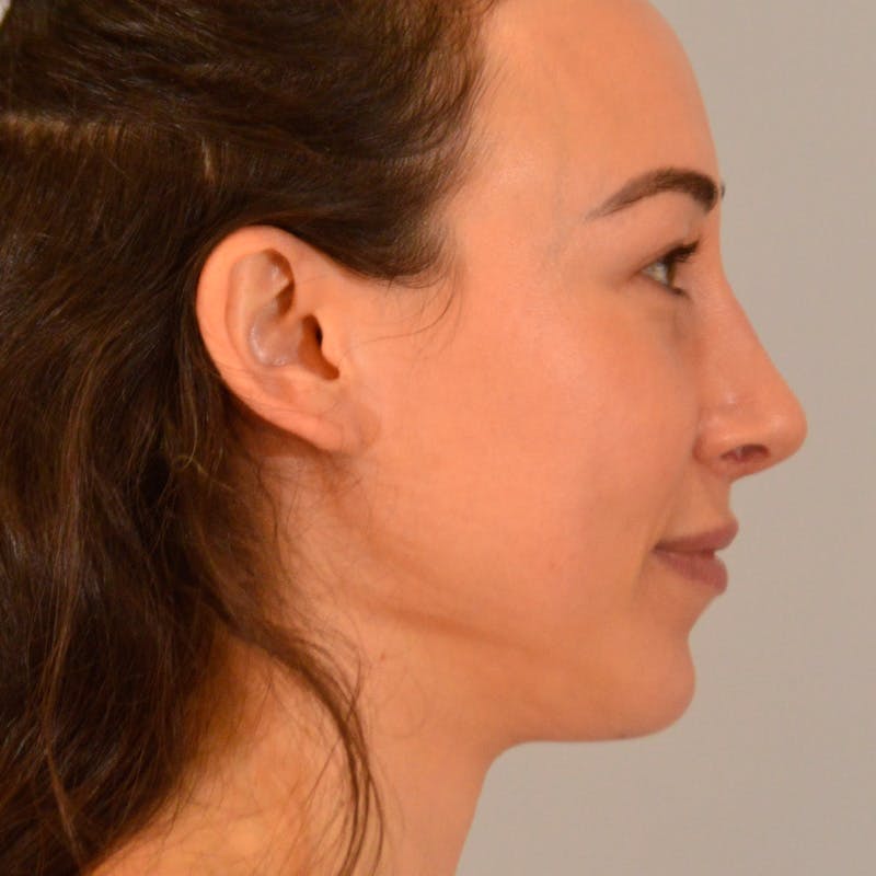 Female Rhinoplasty Before & After Gallery - Patient 167928 - Image 4