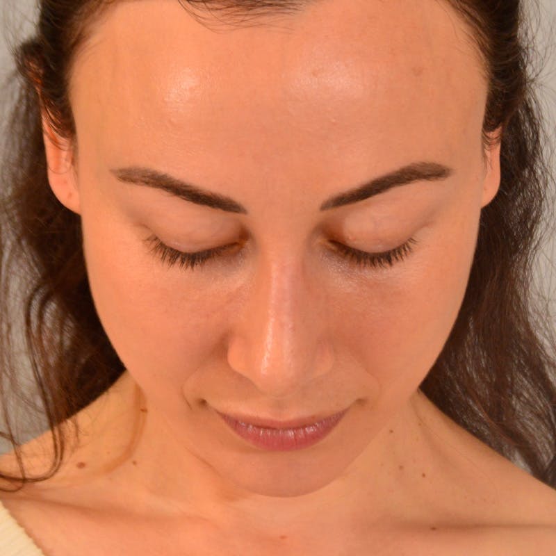 Female Rhinoplasty Before & After Gallery - Patient 167928 - Image 16