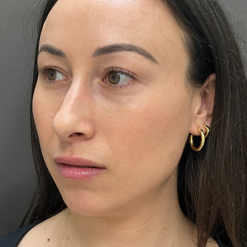 Female Rhinoplasty Before & After Gallery - Patient 167928 - Image 9
