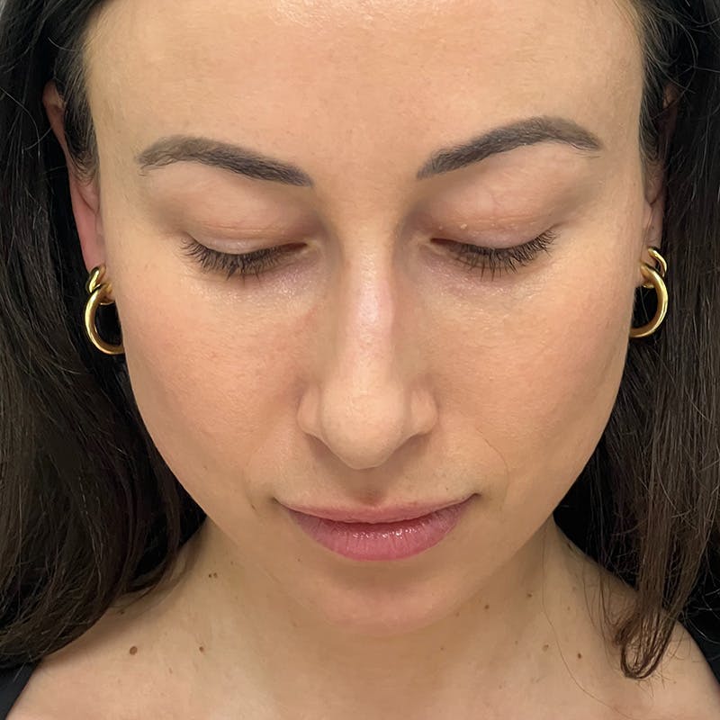 Female Rhinoplasty Before & After Gallery - Patient 167928 - Image 13