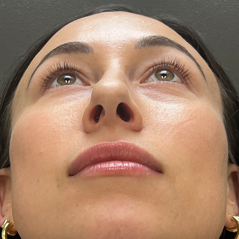 Female Rhinoplasty Before & After Gallery - Patient 167928 - Image 11