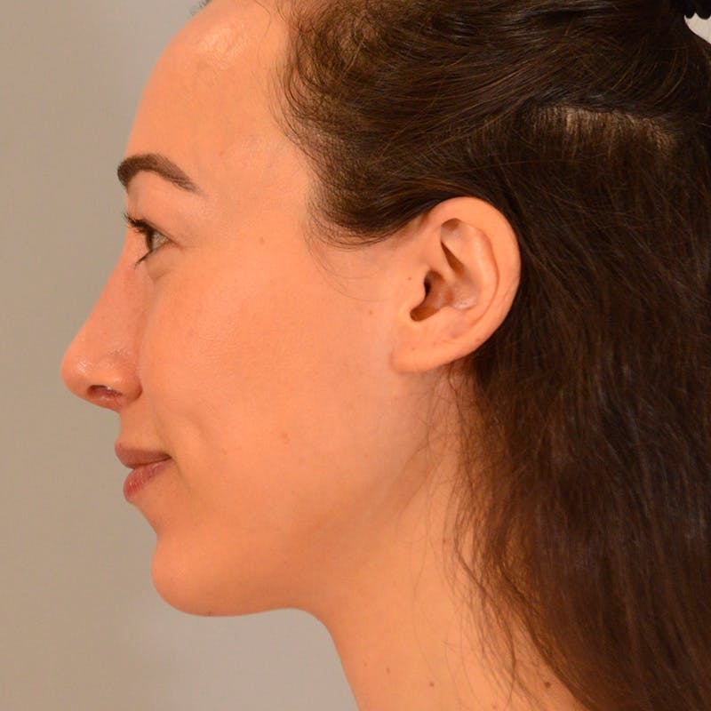 Female Rhinoplasty Before & After Gallery - Patient 167928 - Image 2