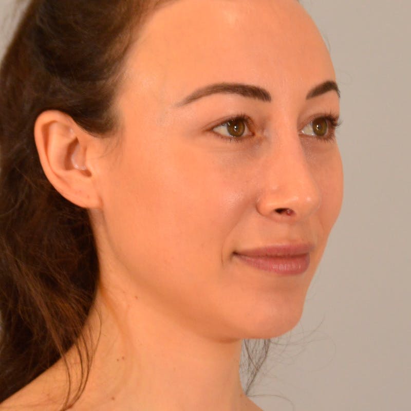 Female Rhinoplasty Before & After Gallery - Patient 167928 - Image 6