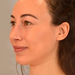 Female Rhinoplasty Before & After Gallery - Patient 167928 - Image 10