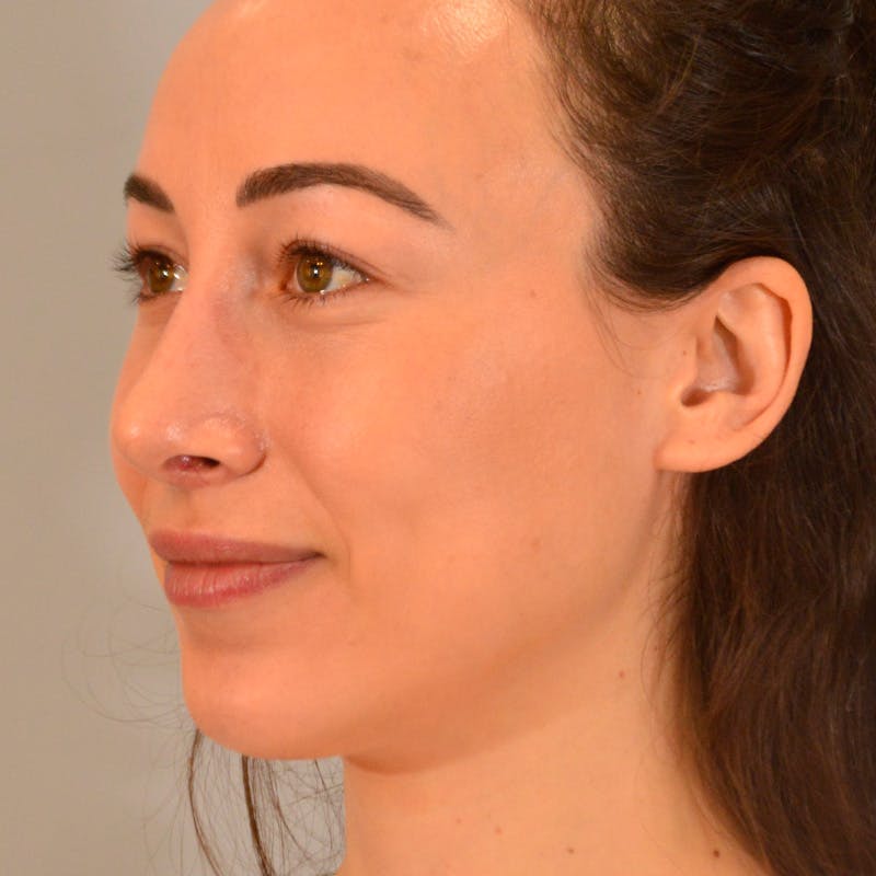 Female Rhinoplasty Before & After Gallery - Patient 167928 - Image 10