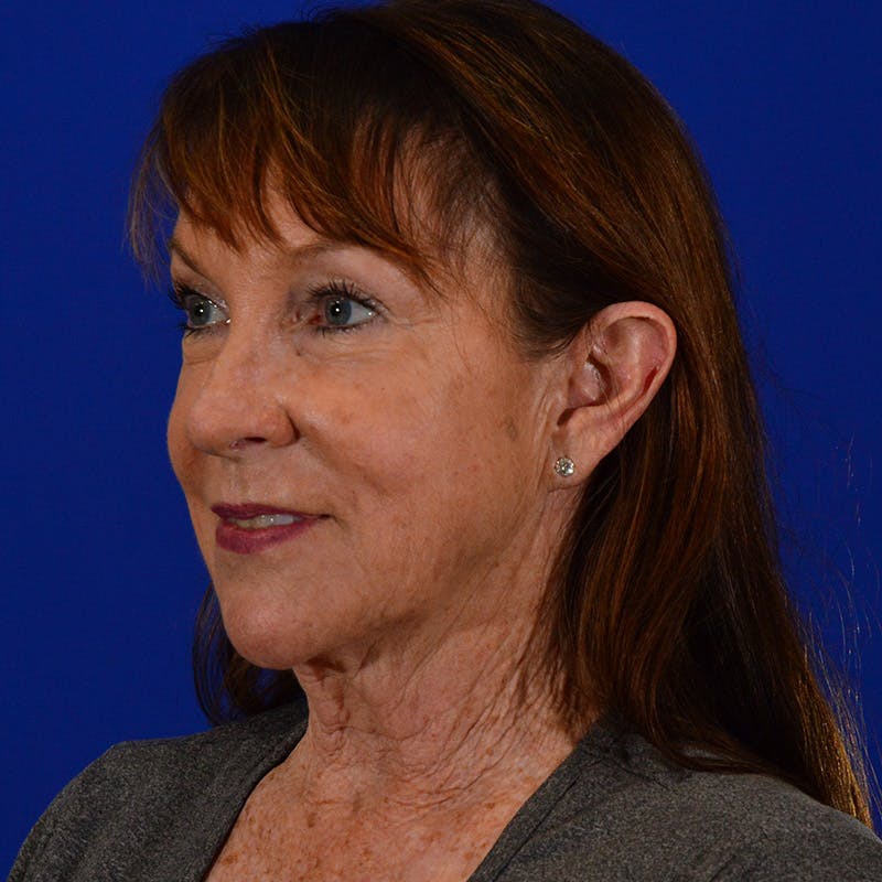 Facelift & Necklift Before & After Gallery - Patient 712813 - Image 7