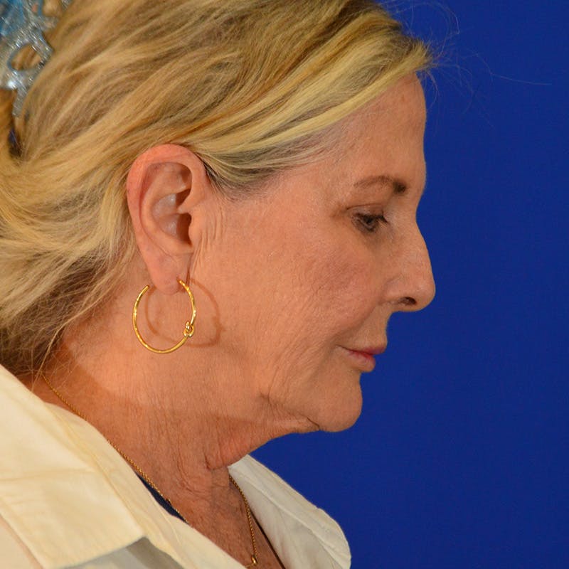 Facelift & Necklift Before & After Gallery - Patient 219676 - Image 7