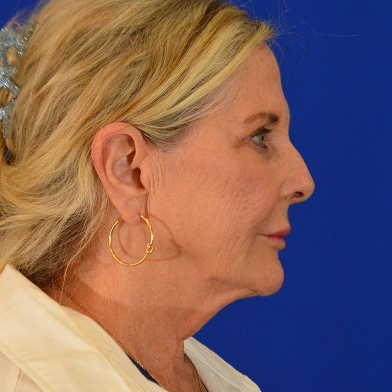 Facelift & Necklift Before & After Gallery - Patient 219676 - Image 5