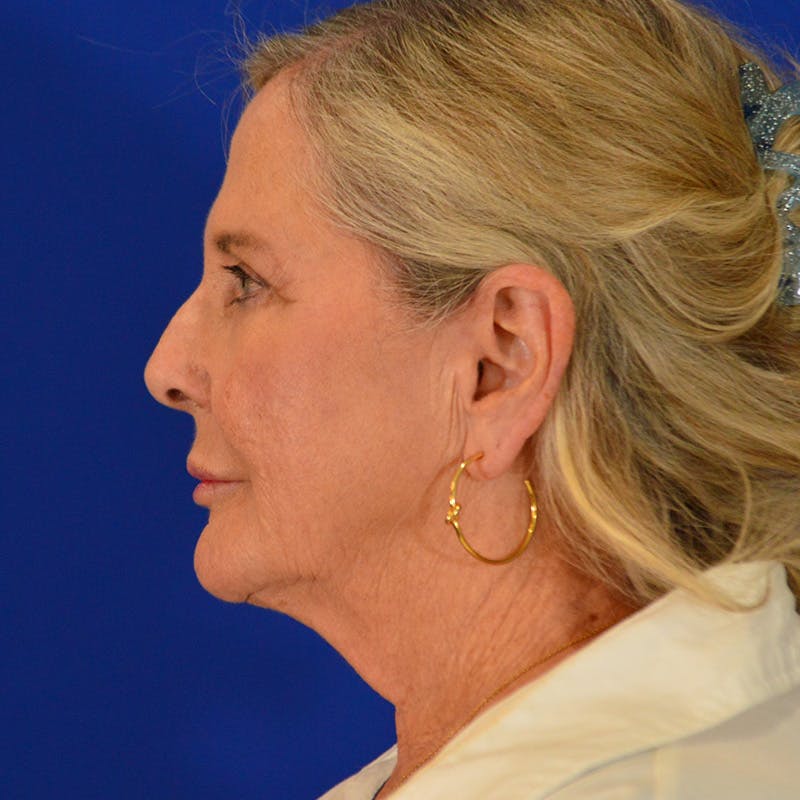 Facelift & Necklift Before & After Gallery - Patient 219676 - Image 11