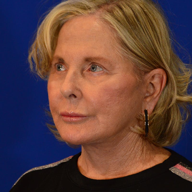 Facelift & Necklift Before & After Gallery - Patient 219676 - Image 10