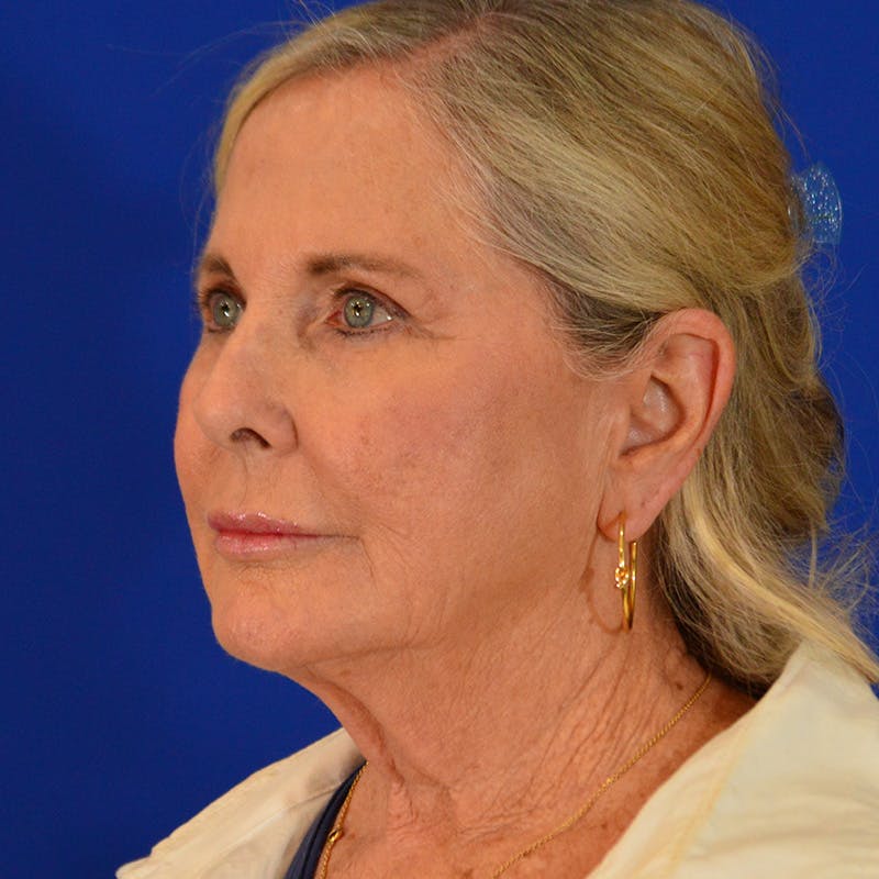 Facelift & Necklift Before & After Gallery - Patient 219676 - Image 9