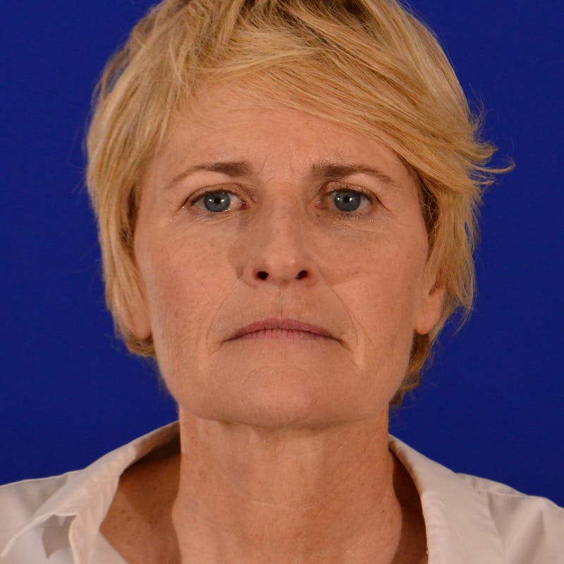 Facelift & Necklift Before & After Gallery - Patient 116568 - Image 1