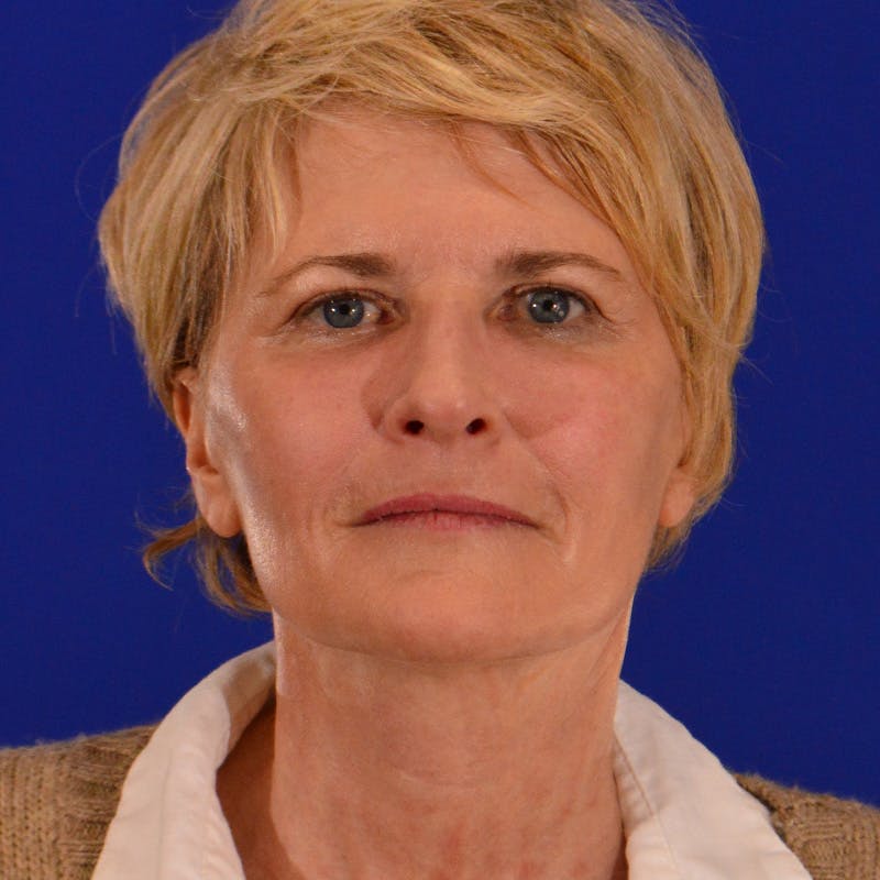 Facelift & Necklift Before & After Gallery - Patient 116568 - Image 2