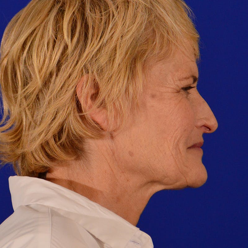 Facelift & Necklift Before & After Gallery - Patient 116568 - Image 5