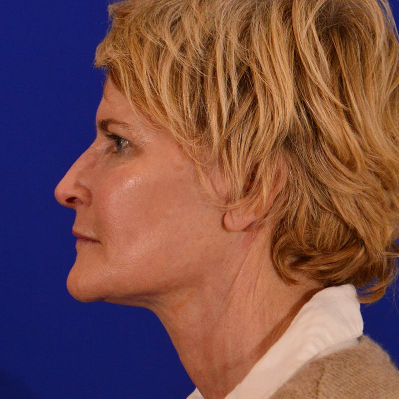 Facelift & Necklift Before & After Gallery - Patient 116568 - Image 10