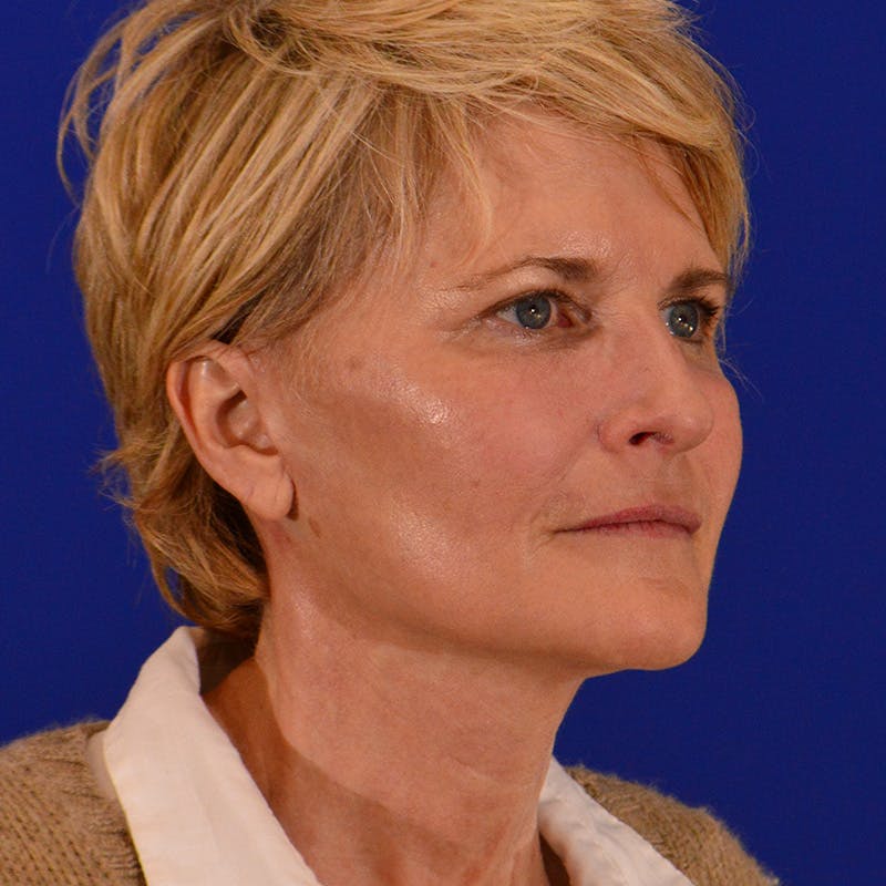 Facelift & Necklift Before & After Gallery - Patient 116568 - Image 4