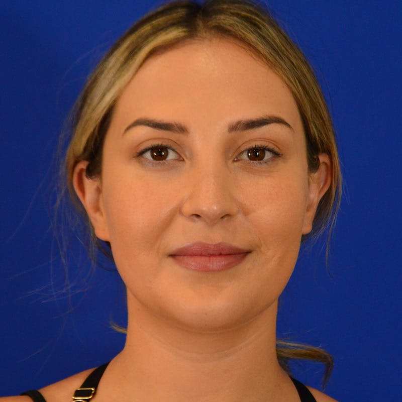 Submental Liposuction Before & After Gallery - Patient 343713 - Image 5