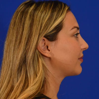 Submental Liposuction Before & After Gallery - Patient 343713 - Image 2