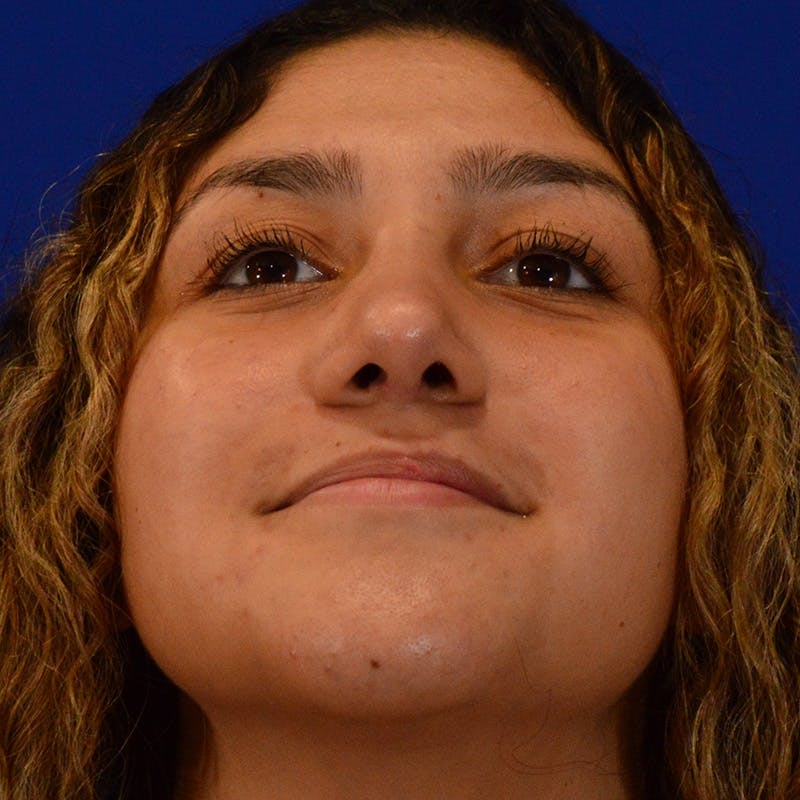 Ethnic Rhinoplasty Before & After Gallery - Patient 407842 - Image 14