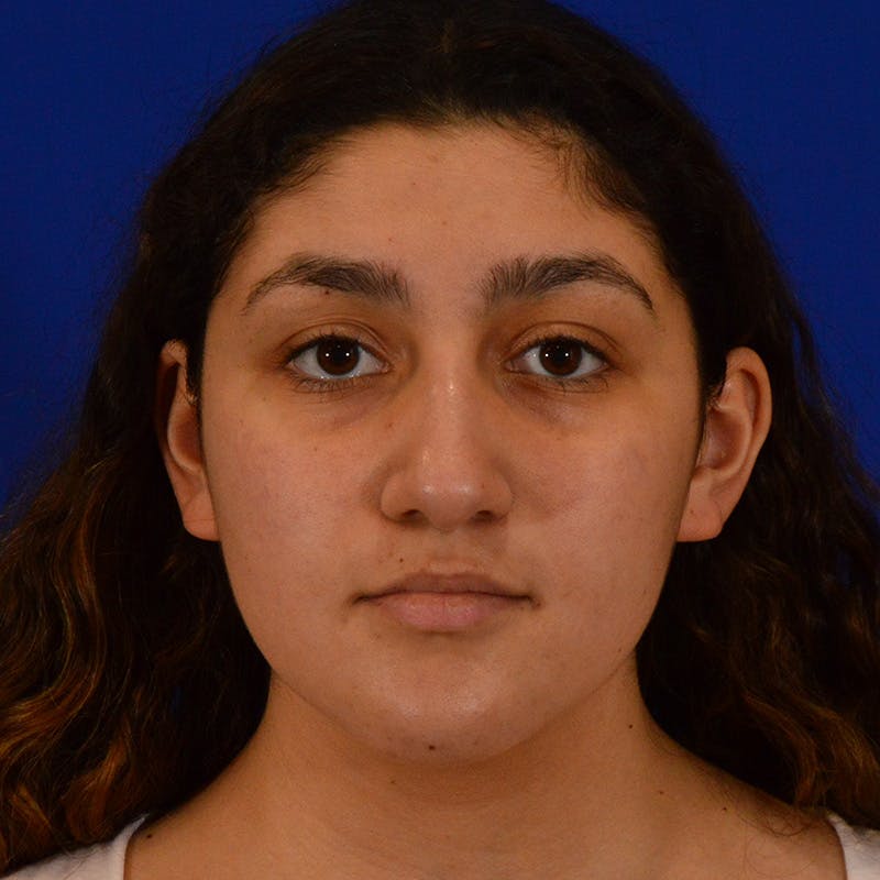 Ethnic Rhinoplasty Before & After Gallery - Patient 407842 - Image 5