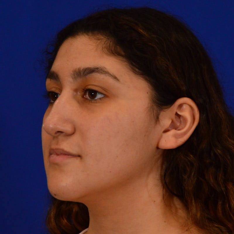 Ethnic Rhinoplasty Before & After Gallery - Patient 407842 - Image 7