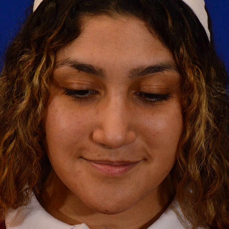 Ethnic Rhinoplasty Before & After Gallery - Patient 407842 - Image 12