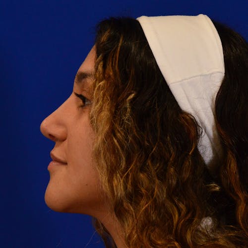 rhinoplasty patient after Beverly Hills by Dr. Torkian