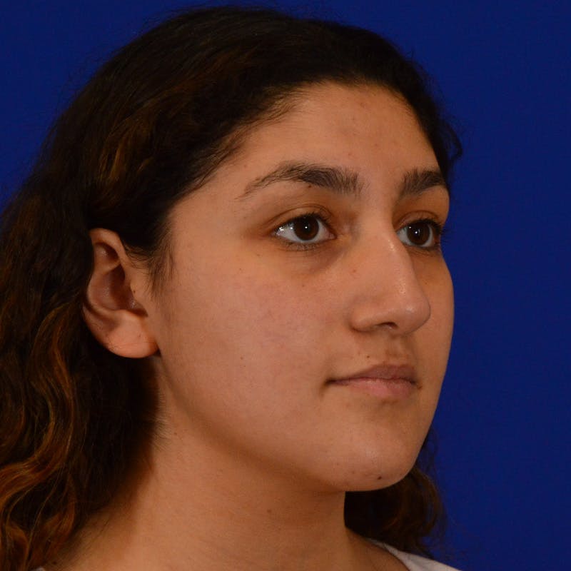 Ethnic Rhinoplasty Before & After Gallery - Patient 407842 - Image 9
