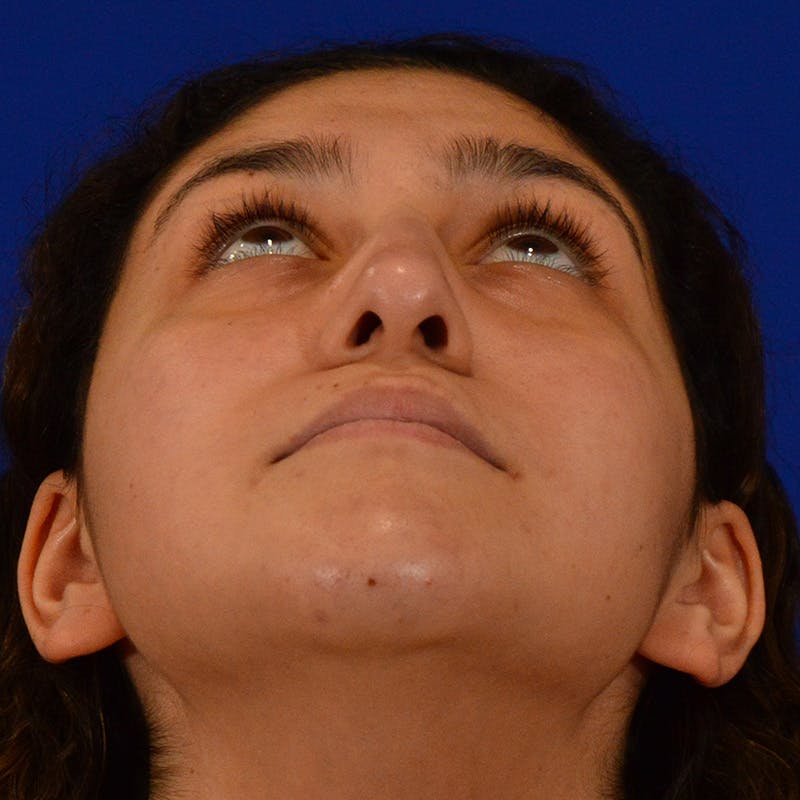 Ethnic Rhinoplasty Before & After Gallery - Patient 407842 - Image 13