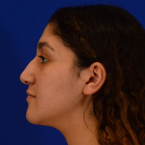 rhinoplasty patient before Beverly Hills by Dr. Torkian