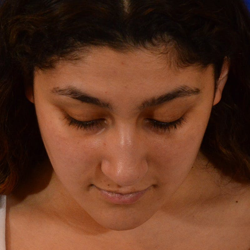 Ethnic Rhinoplasty Before & After Gallery - Patient 407842 - Image 11